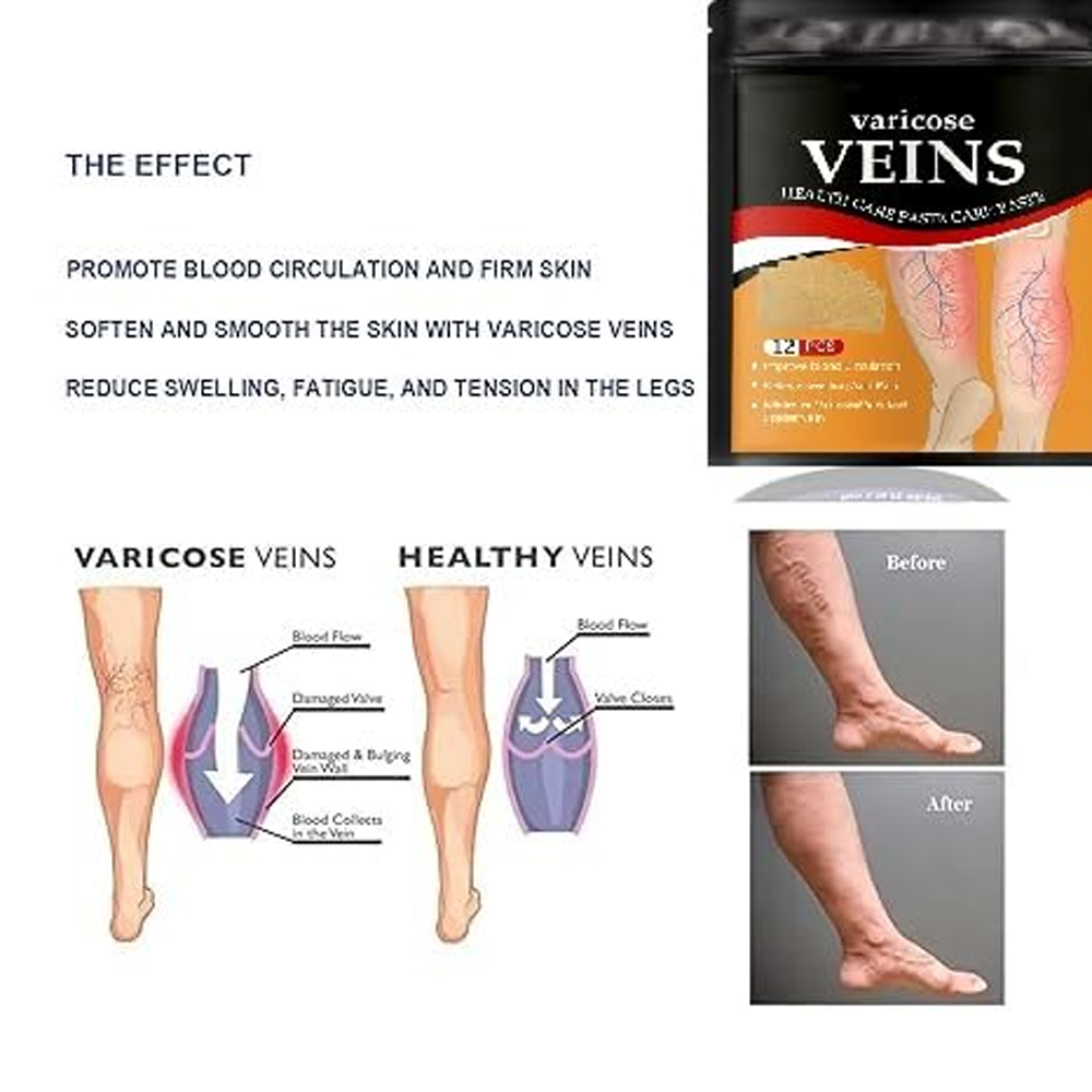 Varicose Veins Relief Patch | Herbal Leg Care Pads for Pain, Swelling & Blood Circulation Support (12 PCS)