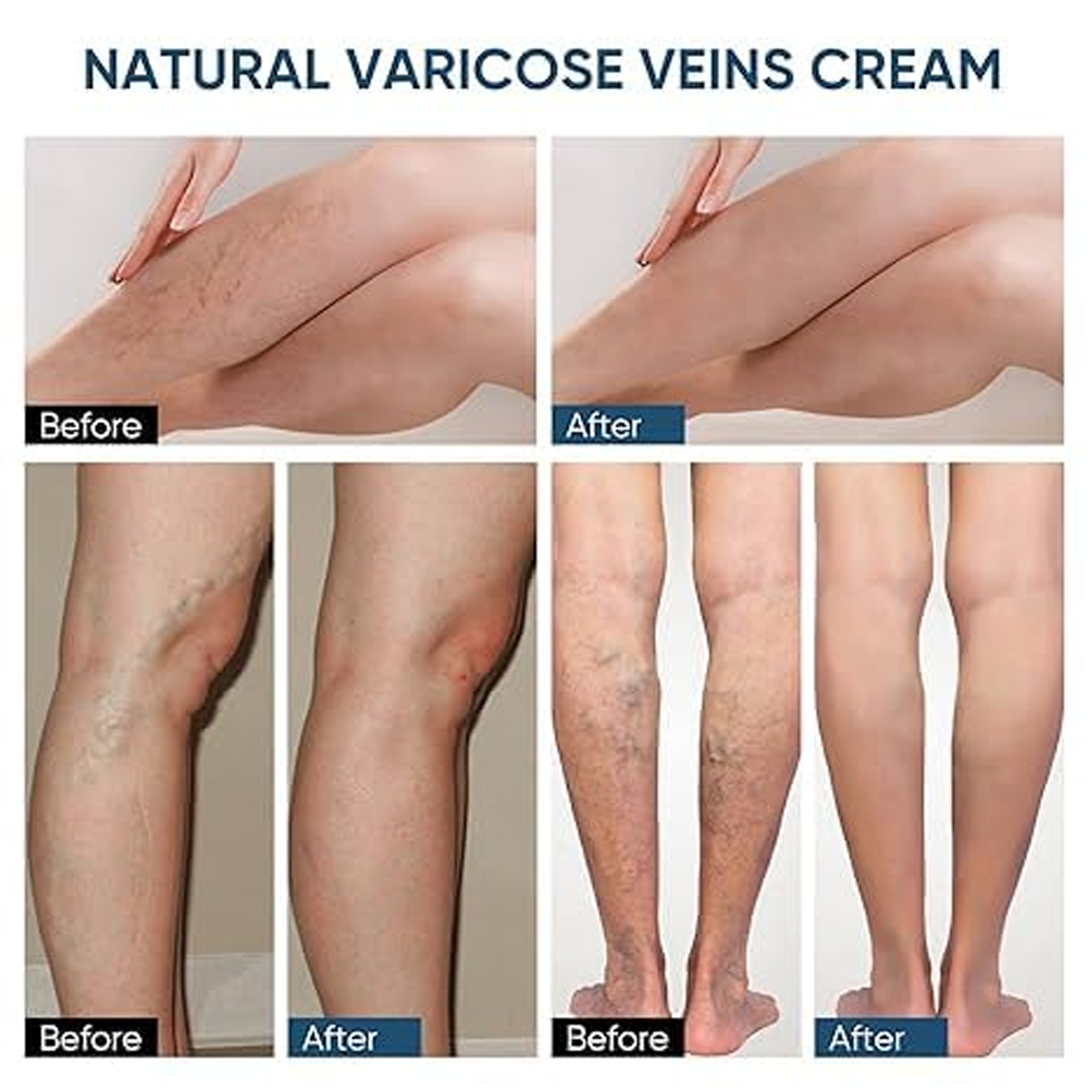 Varicose Veins Relief Patch | Herbal Leg Care Pads for Pain, Swelling & Blood Circulation Support (12 PCS)
